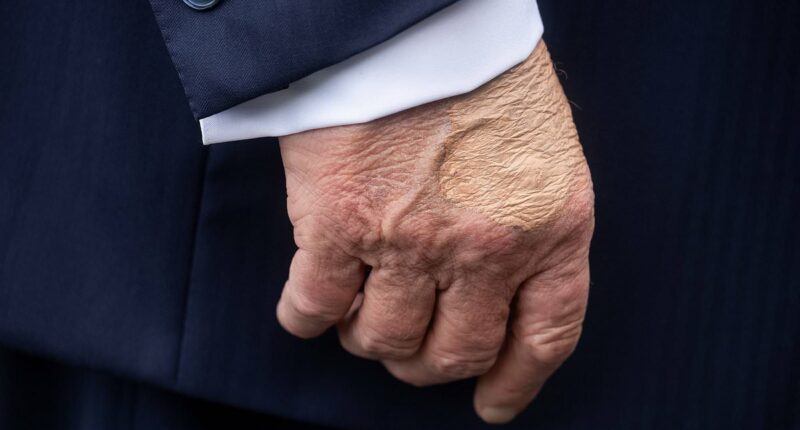 White House reveals Trump's 'chronic' health condition as he suffers swelling and bruises