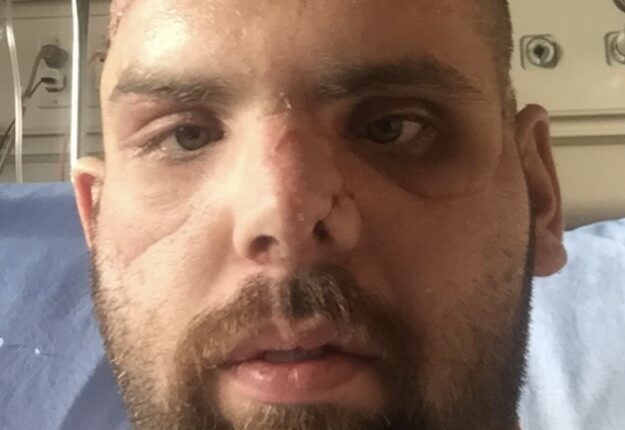 Man with severe facial injuries from a grizzly bear attack.