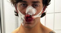 Man with severe facial injuries and blood-soaked bandages.