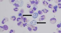 Brain-eating amoeba infection: What to know after Missouri case confirmed