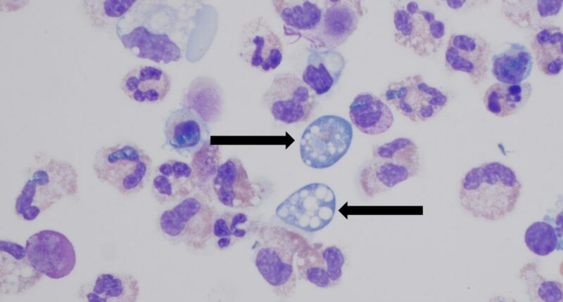 Brain-eating amoeba infection: What to know after Missouri case confirmed