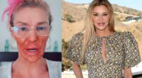 Brandi Glanville Burns Face With Nair Amid Battle With Facial Parasite ‘Caroline’ in Bizarre TikTok
