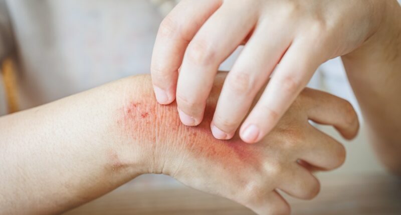 California outbreak of flea-borne typhus infections investigated