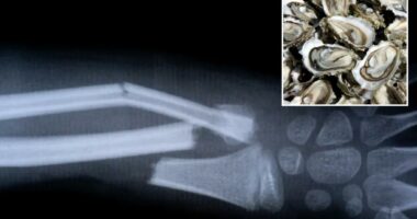 China made Bone 02 glue fixes fractures in just three minutes with one injection