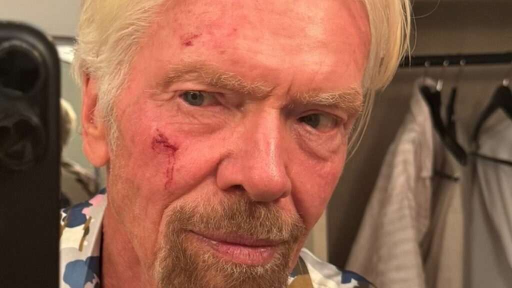 Richard Branson, 75, shows off his painful bleeding cheek