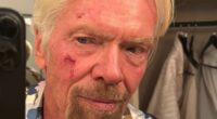 Richard Branson, 75, shows off his painful bleeding cheek