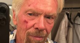 Richard Branson, 75, shows off his painful bleeding cheek