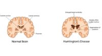 Huntington's disease successfully treated in 1st major breakthrough