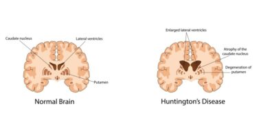 Huntington's disease successfully treated in 1st major breakthrough