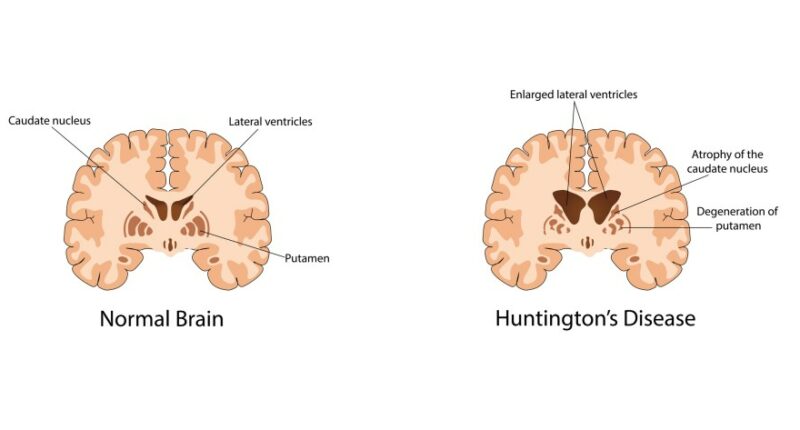 Huntington's disease successfully treated in 1st major breakthrough