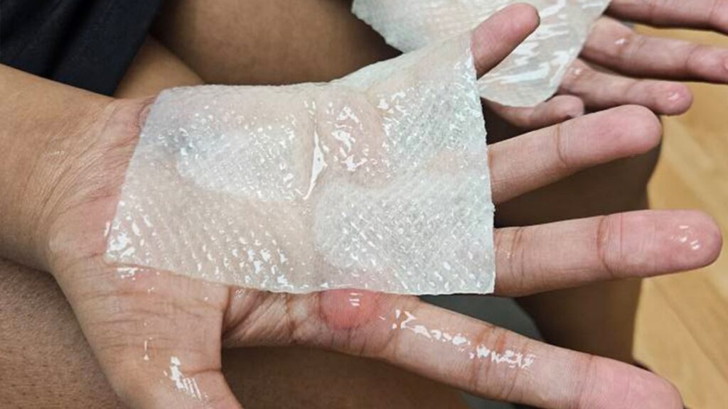 Indiana students get second-degree burns from punishment