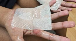 Indiana students get second-degree burns from punishment
