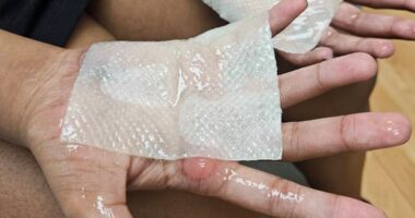 Indiana students get second-degree burns from punishment