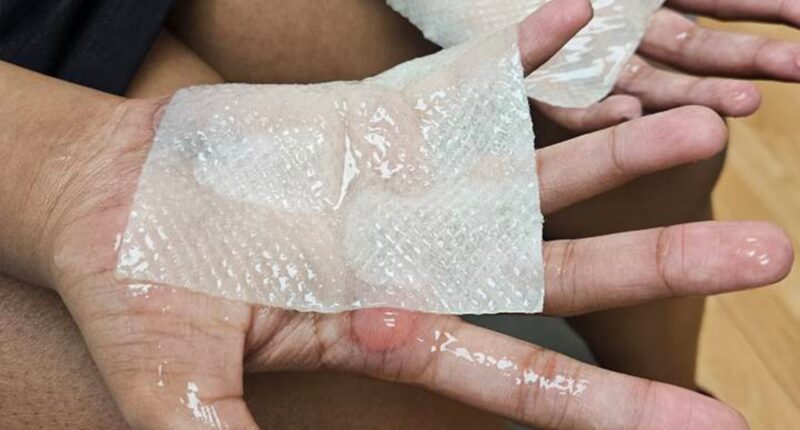 Indiana students get second-degree burns from punishment