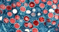 1st in-country transmission of new mpox strain confirmed in US