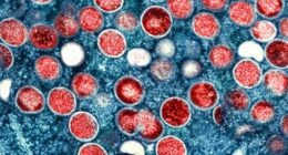 1st in-country transmission of new mpox strain confirmed in US