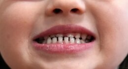 FILE - A child shows off her teeth after a dental exam in Concord, N.H., Wednesday, Feb. 21, 2024. (AP Photo/Robert F. Bukaty, file)
