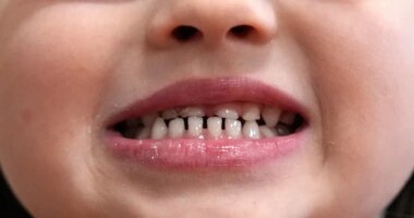 FILE - A child shows off her teeth after a dental exam in Concord, N.H., Wednesday, Feb. 21, 2024. (AP Photo/Robert F. Bukaty, file)