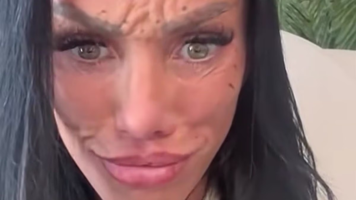 Katie Price reveals concerning HUMPS on her forehead following Botox injections after she sparked outrage over 'blackface' transformation