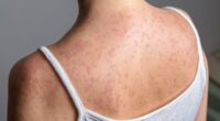Measles outbreak spreads to new state as cases in US hit record high