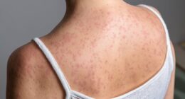 Measles outbreak spreads to new state as cases in US hit record high