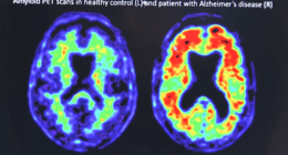 South Carolina struggles with neurologist shortage, rising dementia