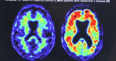 South Carolina struggles with neurologist shortage, rising dementia