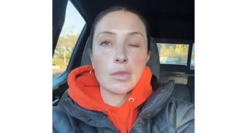 Bristol Palin Says Face Is 'Still Crooked' 1 Year After Paralysis Battle