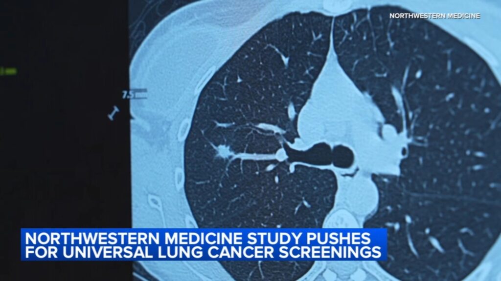 Northwestern Medicine study recommends expanding ages for lung cancer screening