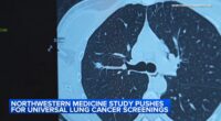 Northwestern Medicine study recommends expanding ages for lung cancer screening