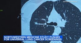 Northwestern Medicine study recommends expanding ages for lung cancer screening