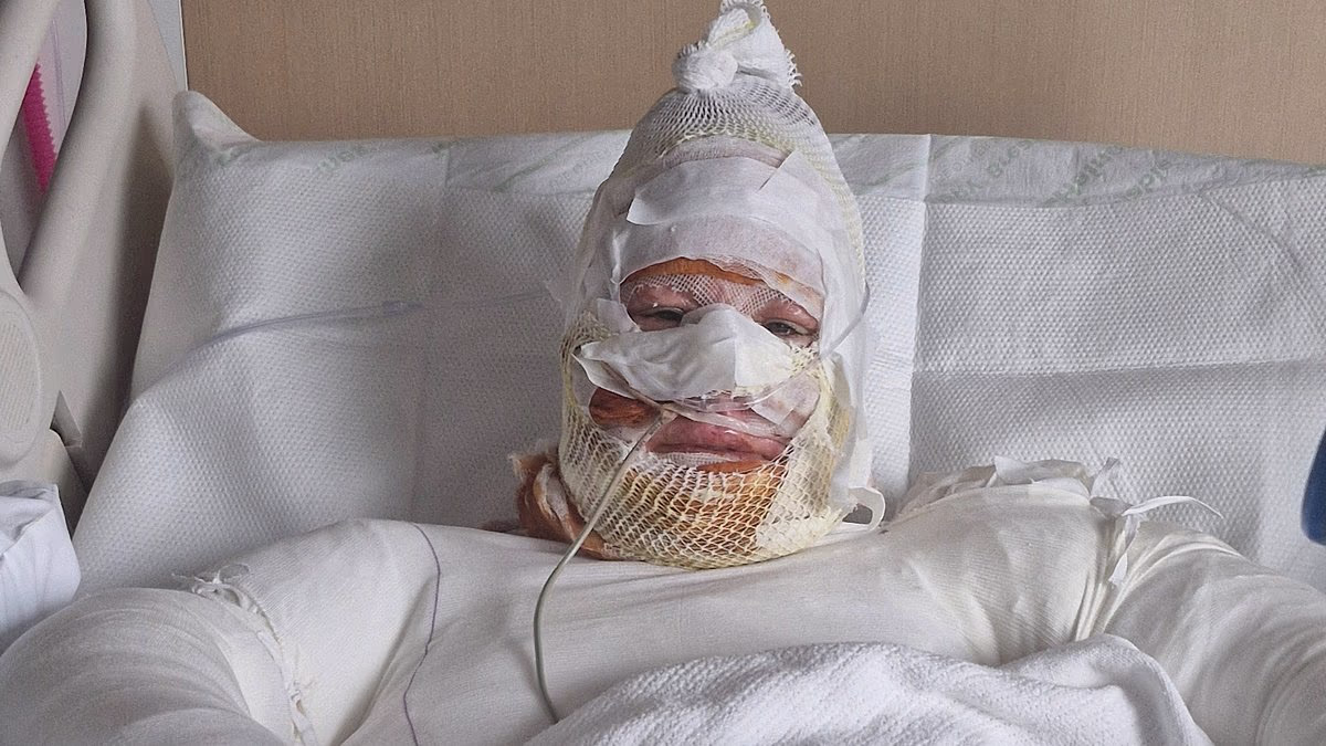 Single mother-of-two is left with horrific burns after her car was FIREBOMBED by an unknown attacker