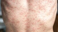 9 new measles cases reported in Upstate Outbreak, 144 total