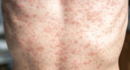 9 new measles cases reported in Upstate Outbreak, 144 total