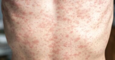 9 new measles cases reported in Upstate Outbreak, 144 total