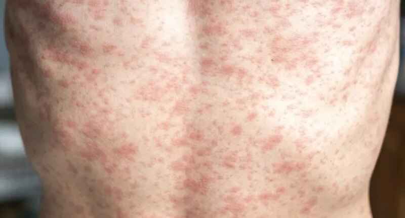 9 new measles cases reported in Upstate Outbreak, 144 total
