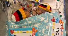 O﻿ne of the conjoined twins who were flown from Papua New Guinea to Australia in a desperate attempt to save them has died following an emergency surgery.