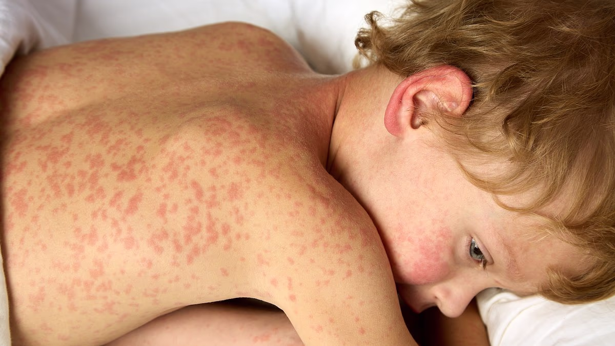 Experts worry about spread of measles... as new 'super' virus rises