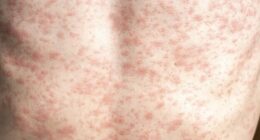 RFK Jr. Needs to 'Unconditionally' Advocate for Measles Vaccine, Lack of Vaccination Causing Deaths, Outbreak