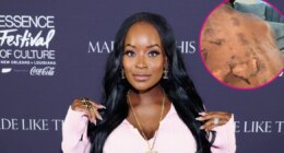 RHOA’s Shamea Morton Sues Doctor Over Chemical Peel Gone Wrong