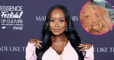 RHOA’s Shamea Morton Sues Doctor Over Chemical Peel Gone Wrong