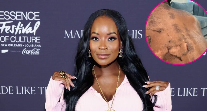 RHOA’s Shamea Morton Sues Doctor Over Chemical Peel Gone Wrong