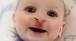 Tiny medical mouthpiece can eliminate a surgery for babies with cleft lip, palate