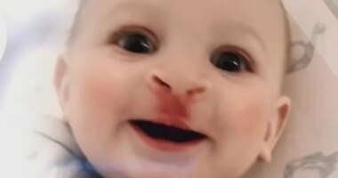 Tiny medical mouthpiece can eliminate a surgery for babies with cleft lip, palate