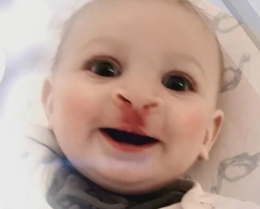 Tiny medical mouthpiece can eliminate a surgery for babies with cleft lip, palate