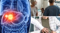 'Troubling' colorectal cancer complication is highest in those under 50