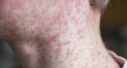 Despite Upstate measles outbreak, vaccination rates remain low