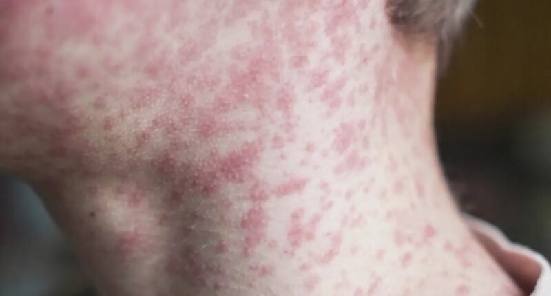 Despite Upstate measles outbreak, vaccination rates remain low