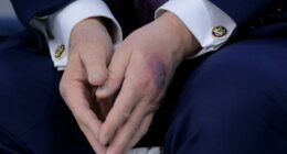 The large black and red bruise seen on Donald Trump's hand.