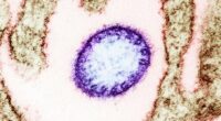 Nipah virus is frequently fatal and can leave survivors with brain damage.